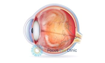 Vitreale Loslating 2 Focus Eye Clinic
