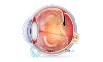 Netvliesscheur 2 Focus Eye Clinic