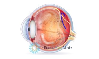 Netvliesloslating 2 Focus Eye Clinic